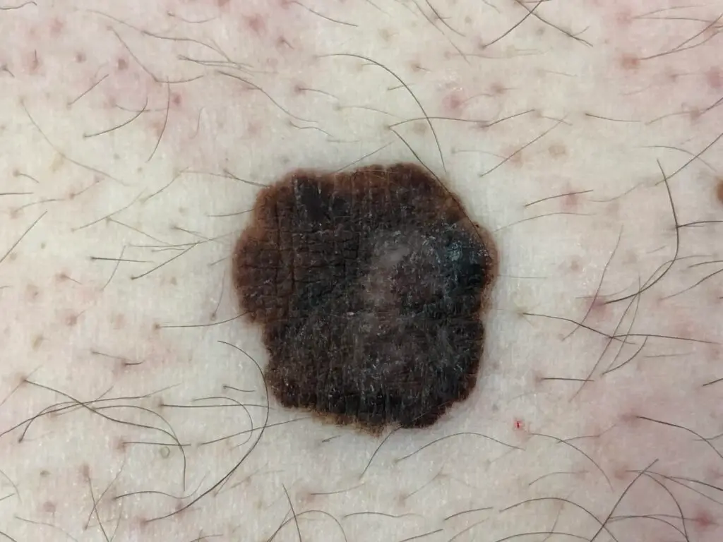 Promjena na koži koja može upućivati na rak kože