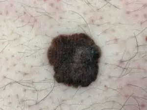 Promjena na koži koja može upućivati na rak kože