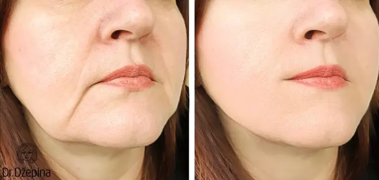 Facelift Vorher Und Nachher