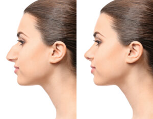 Price I Nakon Rinoplastike Dr Davor Dzepina