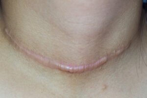 Hipertroficni Oziljak