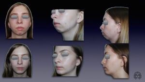 Povecanje Brade Implantom