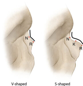 Prezervacijska Rinoplastika Preduvjeti Za Operaciju