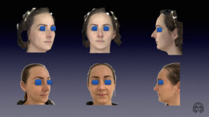 Prezervacijska Rinoplastika Prije I Nakon Zahvata Ultrasonnična Piezo Tehnika