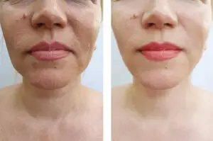 Lifting estetskim nitima prije i nakon tretmana