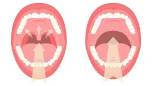 Poboljšanje disanja nakon UPPP