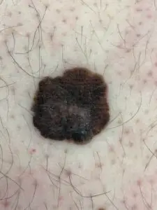 Kozna Promjena Slicna Melanomu